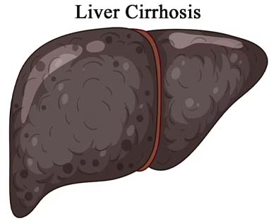 Homeopathy Treatment for Osteoarthritis